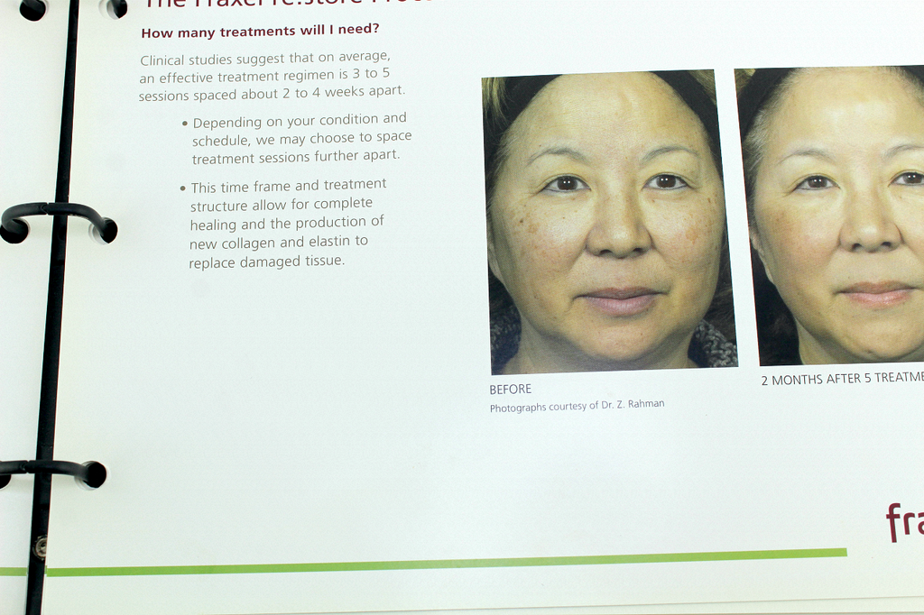 Fraxel re:pair Treatment Patient Diary Before & After Progress