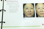 Fraxel re:pair Treatment Patient Diary Before & After Progress