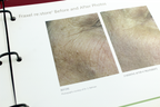 Fraxel re:pair Treatment Patient Diary Before & After Progress