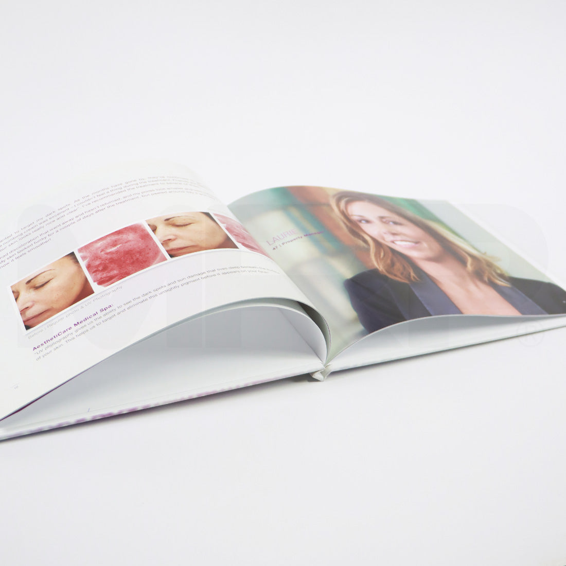 Sciton Halo Fractional Laser Patient Office Marketing Before After Photos Book