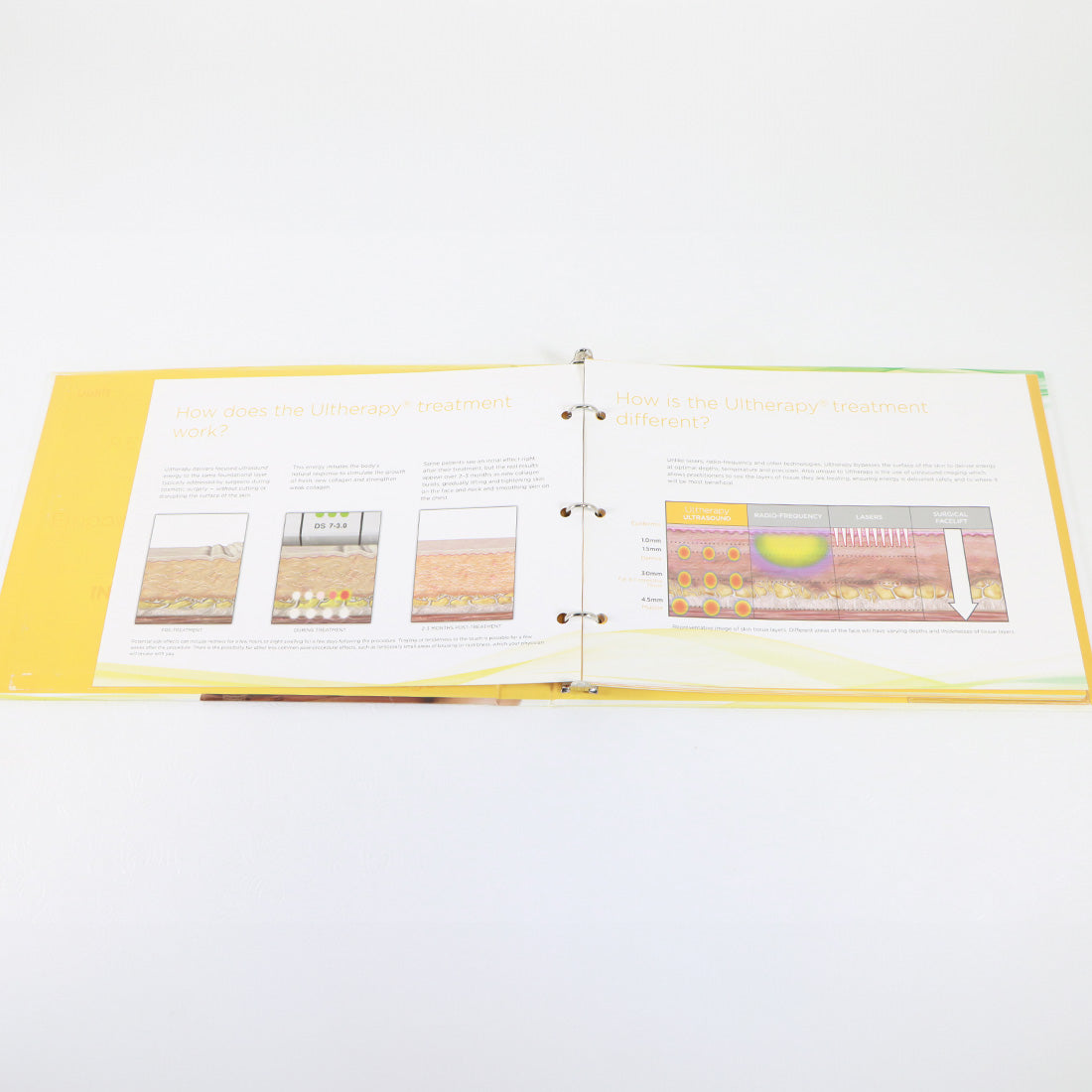 Ultherapy: The Uplifting Solution For Sagging Skin Treatment Info Book 1002554B