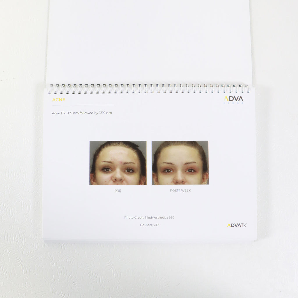 Advalight ADVATx Office BEFORE AFTER Photo Gallery Book Skin Rejuvenation Acne