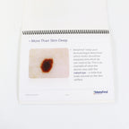 2012 MELA Sciences MelaFind Introduction Standing Marketing Book M100-BR-006