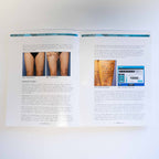 Sciton - Treatment of Lumpy and Dimpled Skin - Case Study / Information Booklet