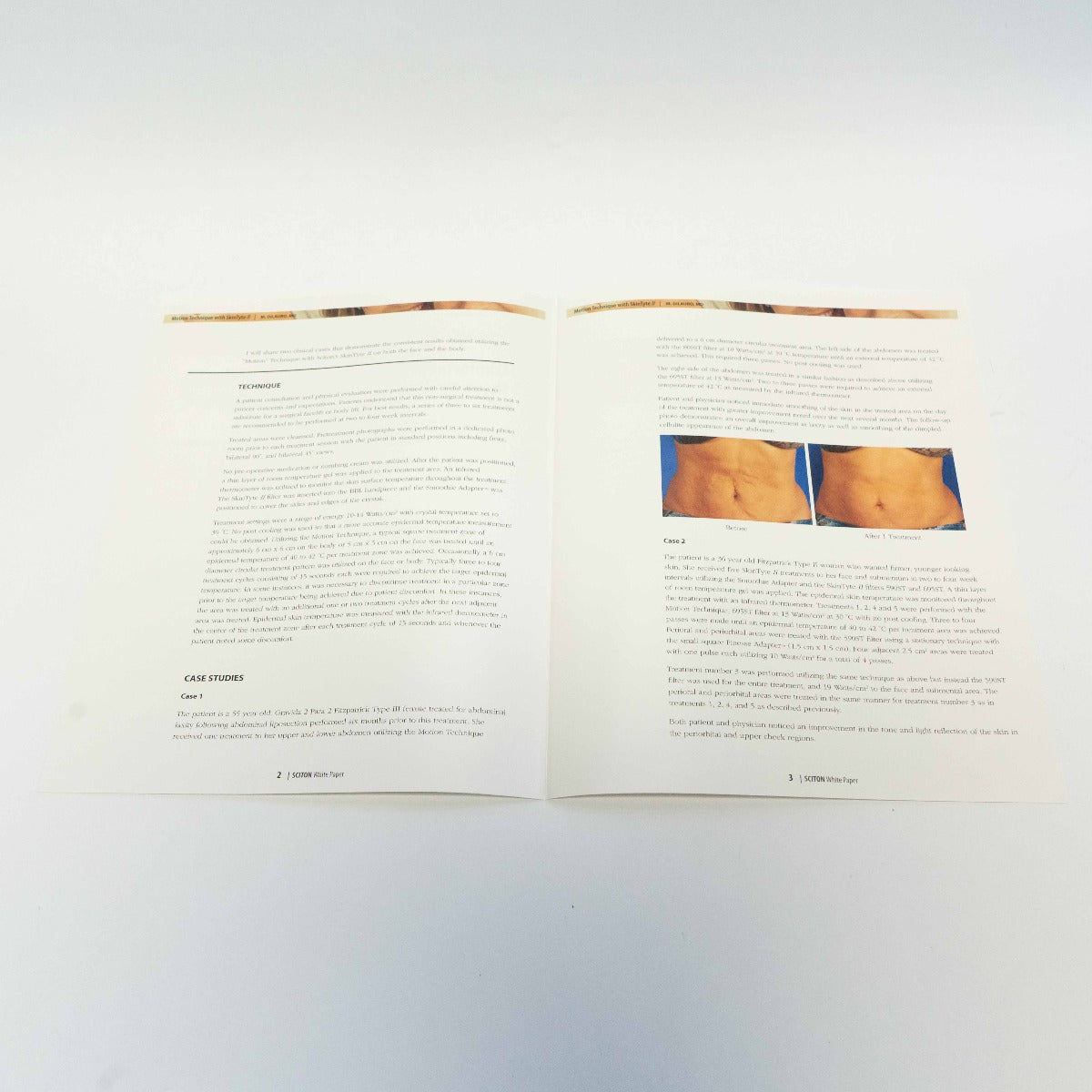 2011 Sciton White Paper - Motion Technique With SkinTyte II - 2600-003-09