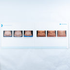 Coolsculpting Show More of Less Patient Informational Before & After Photo Book