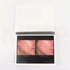 Ulthera Ultherapy Clinical Image Results Manual Open