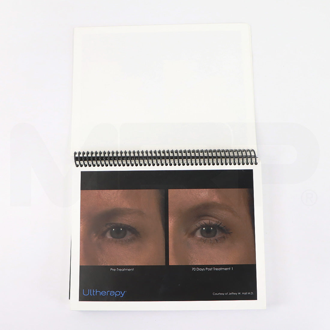 Ulthera Ultherapy Clinical Image Results Manual Page