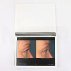 Ulthera Ultherapy Clinical Image Results Manual Page Example