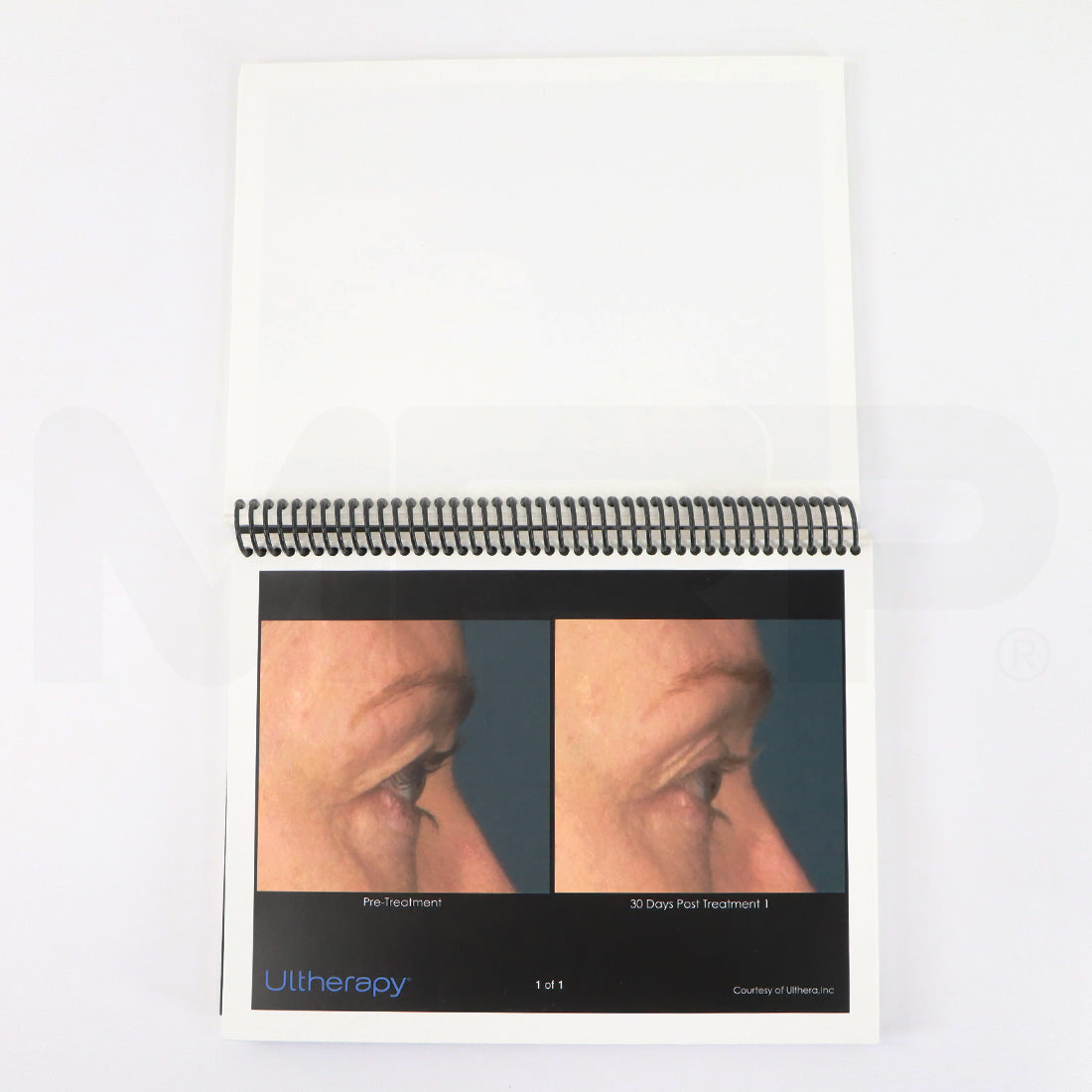 Ulthera Ultherapy Clinical Image Results Manual Page Example