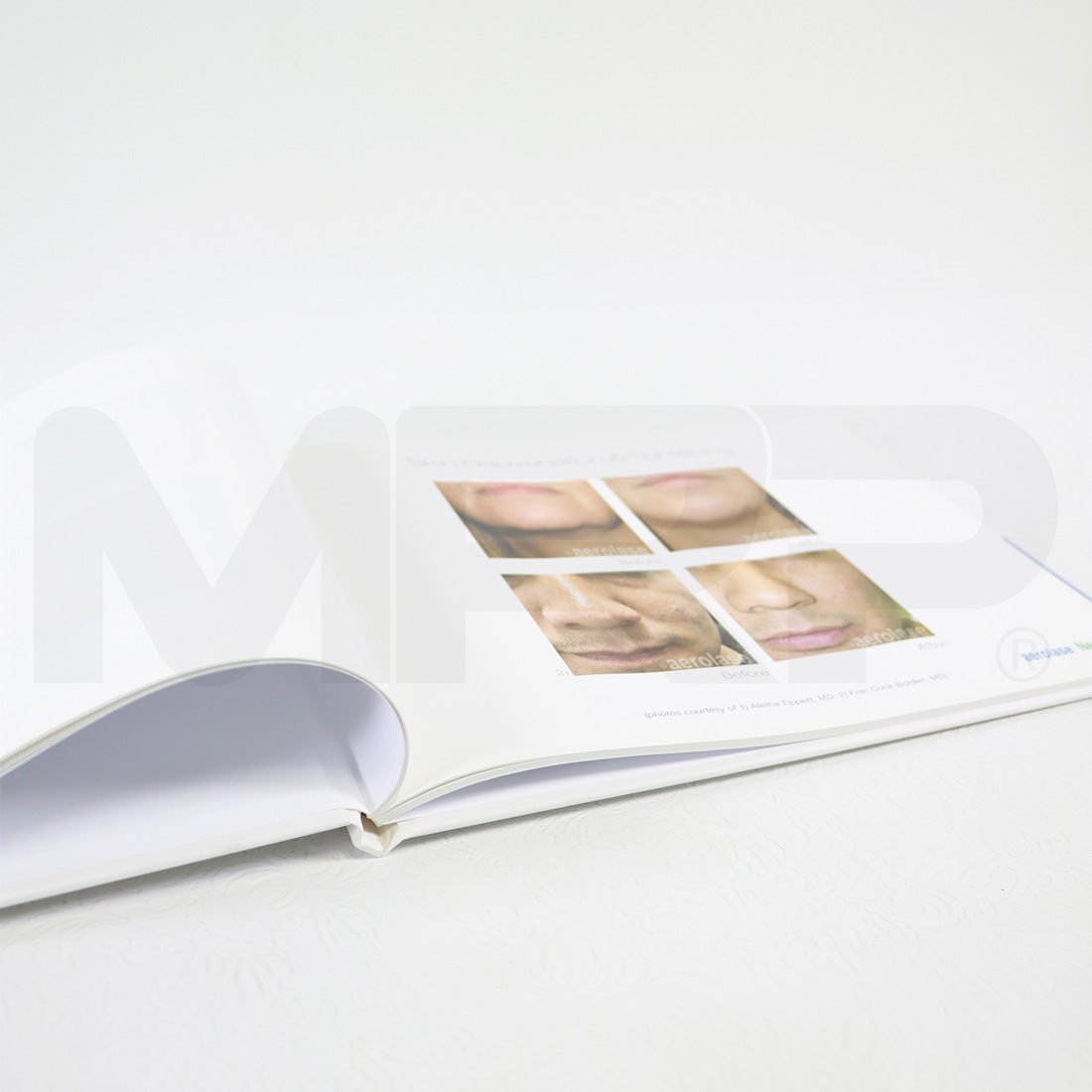 Aerolase Neo Aesthetic Laser Treatment Office Marketing Before After Photos Book