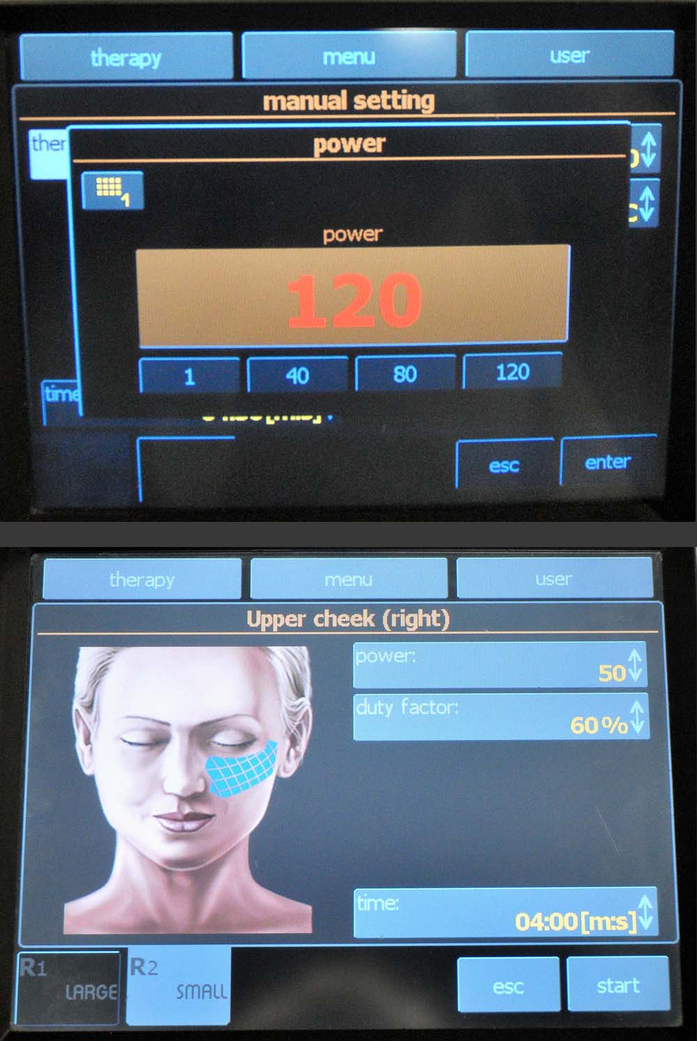 2011 BTL Exilis Elite Radio Frequency 120 Watt Laser Body Shape Skin Tightening