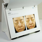 Sciton Laser BECAUSE RESULTS MATTER BBL Halo Contour Patient Before After Photos