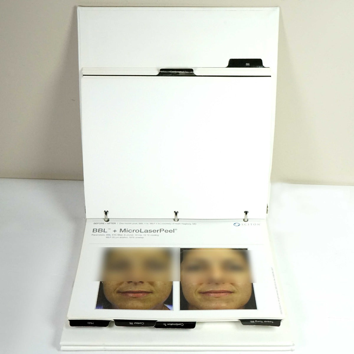 Sciton Laser BECAUSE RESULTS MATTER BBL Halo Contour Patient Before After Photos
