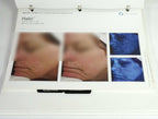 Sciton Laser BECAUSE RESULTS MATTER BBL Halo Contour Patient Before After Photos