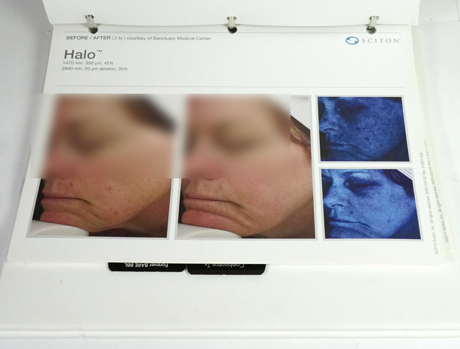 Sciton Laser BECAUSE RESULTS MATTER BBL Halo Contour Patient Before After Photos