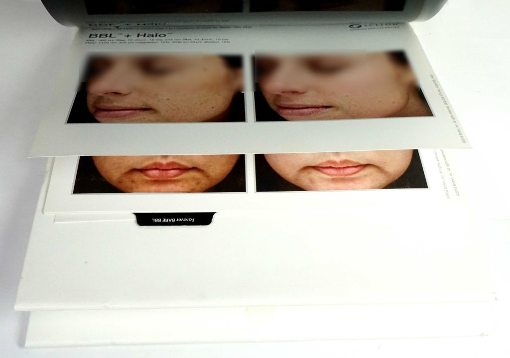 Sciton Laser BECAUSE RESULTS MATTER BBL Halo Contour Patient Before After Photos