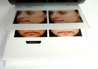 Sciton Laser BECAUSE RESULTS MATTER BBL Halo Contour Patient Before After Photos