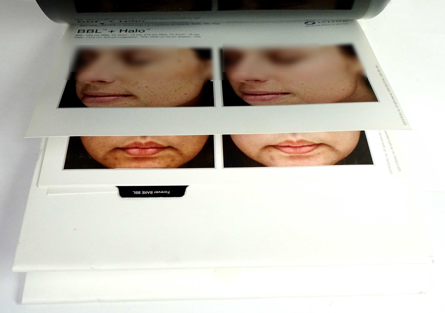 Sciton Laser BECAUSE RESULTS MATTER BBL Halo Contour Patient Before After Photos
