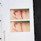 Sciton Laser RESULTS MATTER BBL Halo Patient Before After Photos Marketing Book