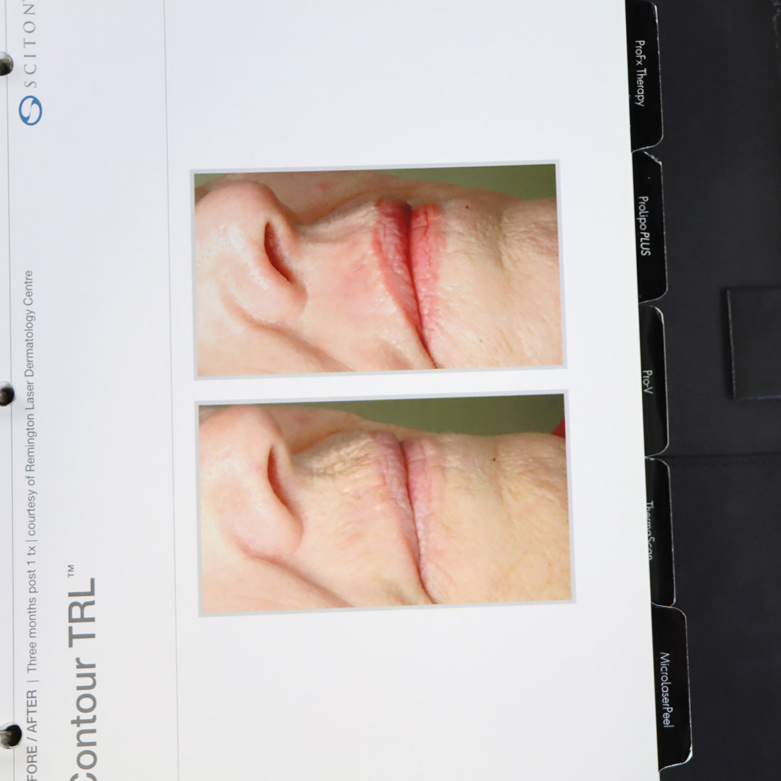 Sciton Laser RESULTS MATTER BBL Halo Patient Before After Photos Marketing Book