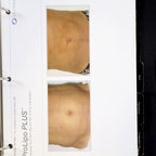 Sciton Laser RESULTS MATTER BBL Halo Patient Before After Photos Marketing Book