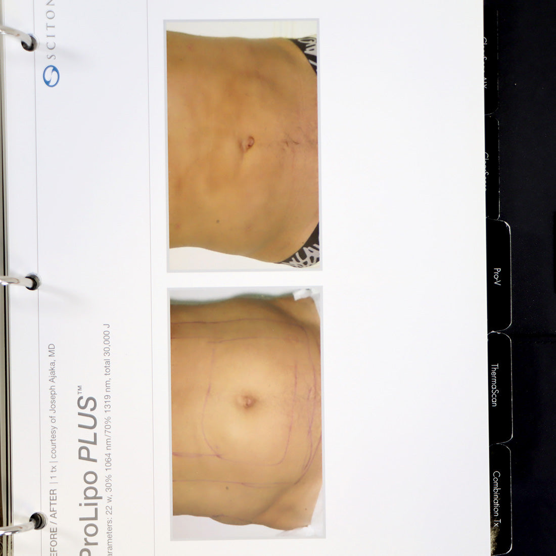 Sciton Laser RESULTS MATTER BBL Halo Patient Before After Photos Marketing Book