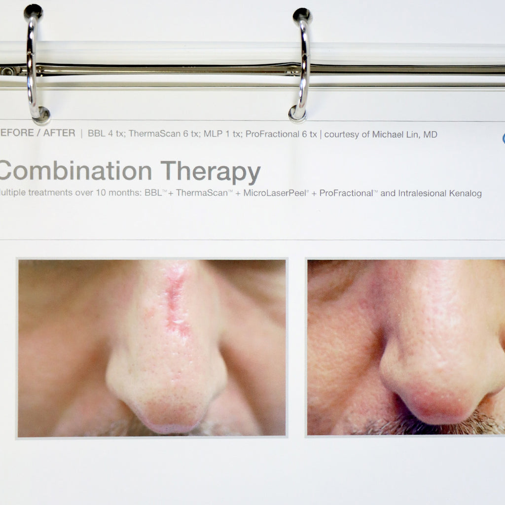 Sciton Laser RESULTS MATTER BBL Halo Patient Before After Photos Marketing Book