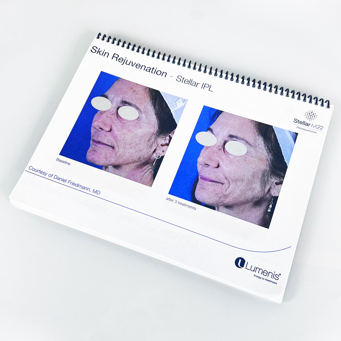 Lumenis Stellar M22 Laser Clinical CaseBook Office Patient Before After Photos