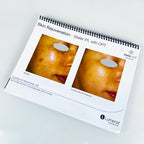 Lumenis Stellar M22 Laser Clinical CaseBook Office Patient Before After Photos