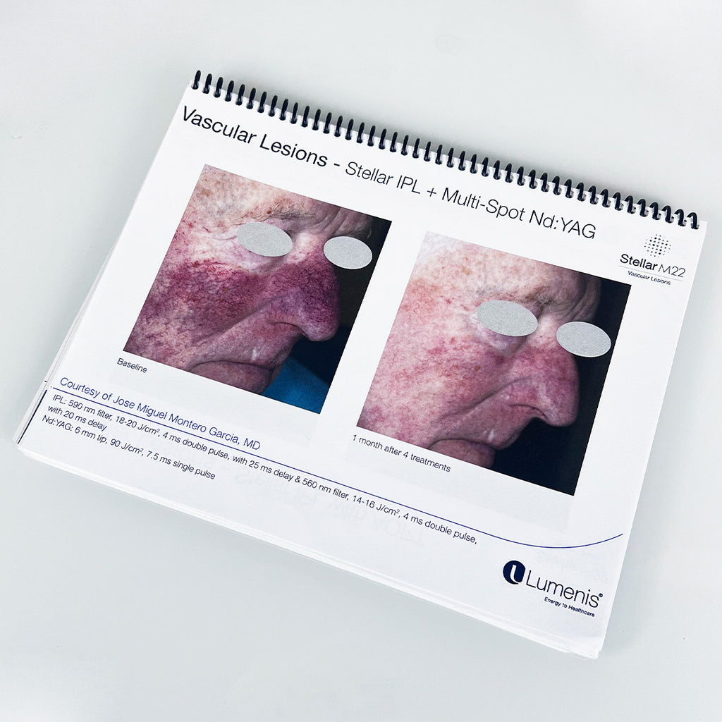Lumenis Stellar M22 Laser Clinical CaseBook Office Patient Before After Photos