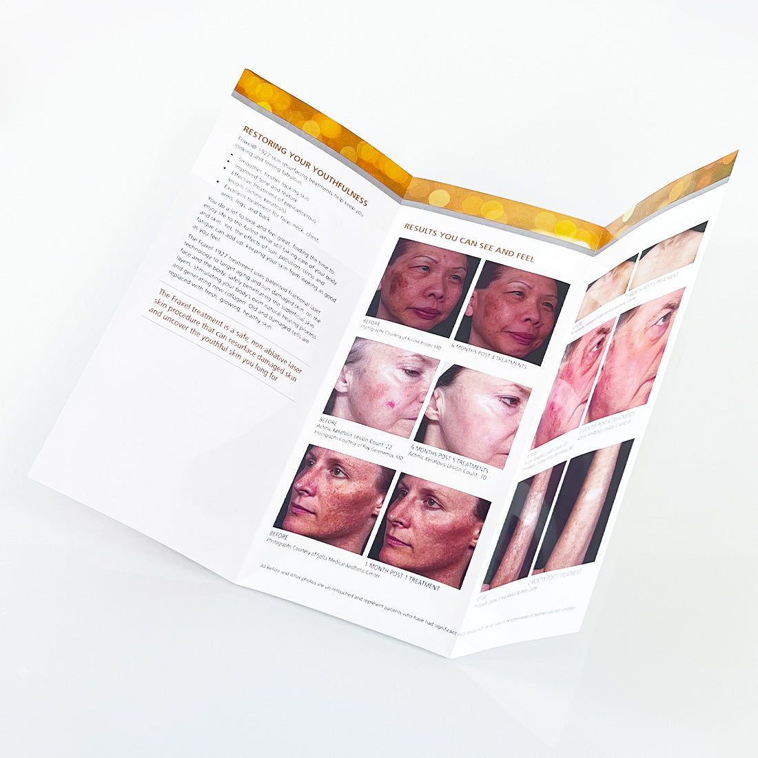 Fraxel 1927 "RADIANT SKIN CAN BE YOURS" Skin Resurfacing Office Brochure x12 Pcs