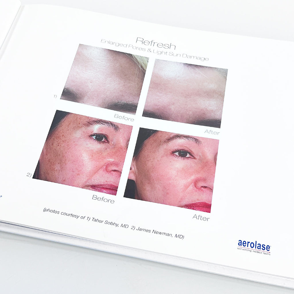 Aerolase Neo Laser Treatment Patient Before After Photos Book Office Marketing
