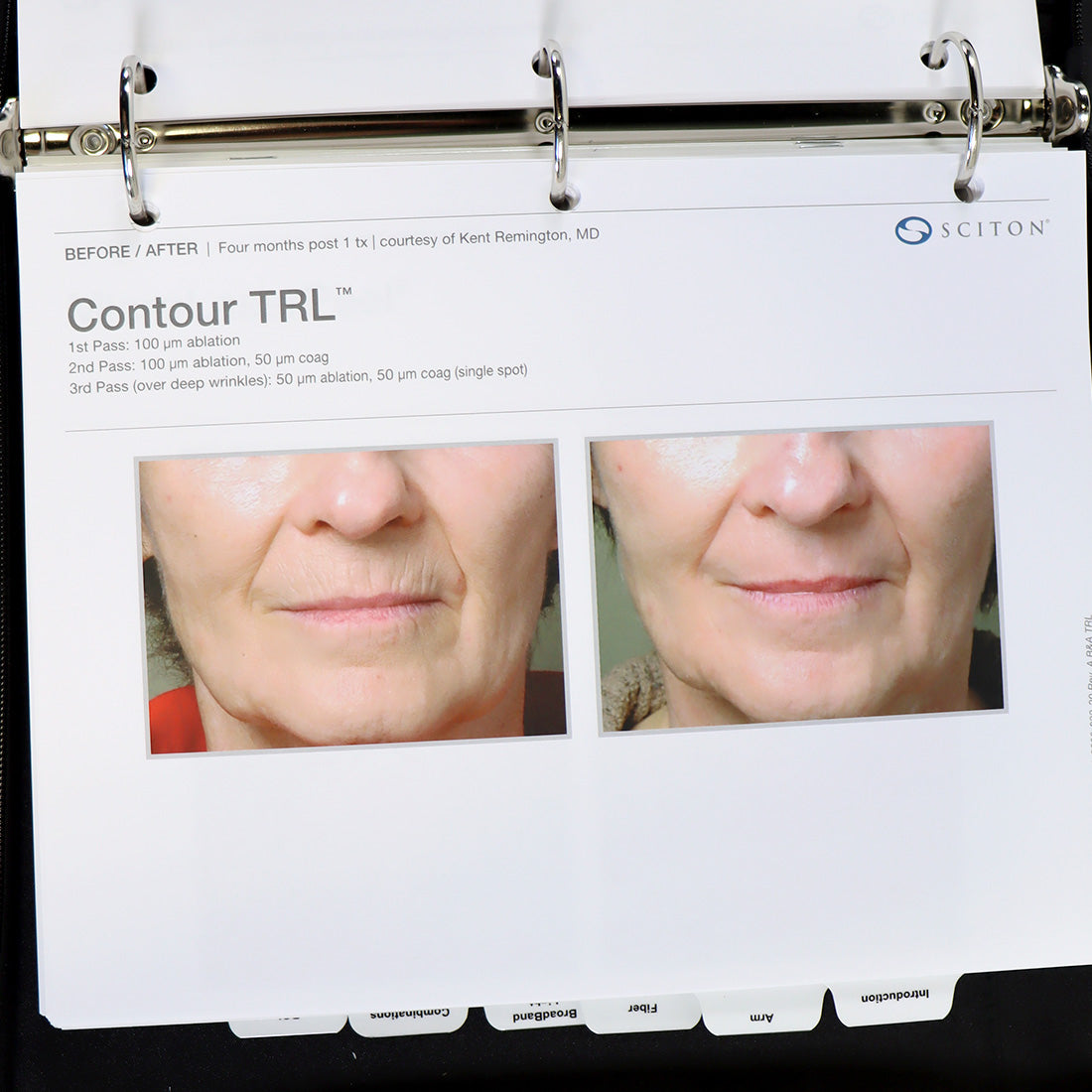 Sciton Seminar Marketing Power Point and Product Description Binder