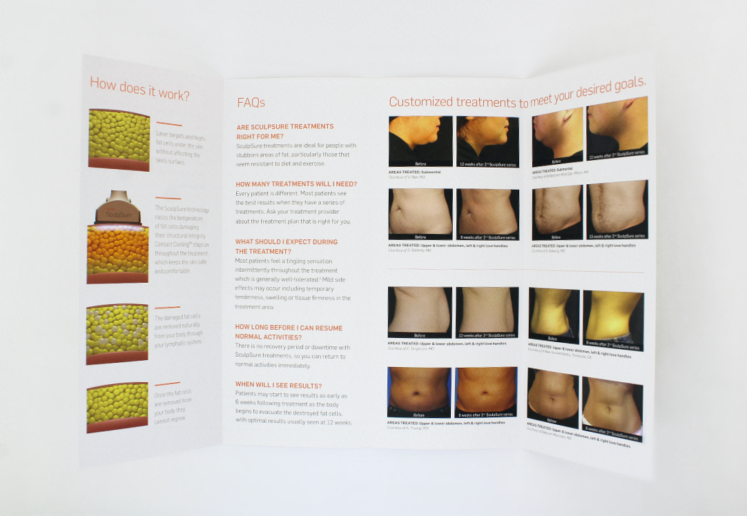 Cynosure SculpSure Permanent Fat Reduction Be Strong. Sexy. Confident Brochure