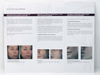 Zarin DEKA SMARTXIDE DOT BROCHURE Skin Resurfacing Acne Office Marketing x50 Pcs