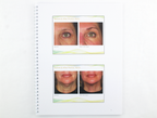 Ulthera Ultherapy Turn Back the Signs of Aging Customer Training 2015 1003213TRN