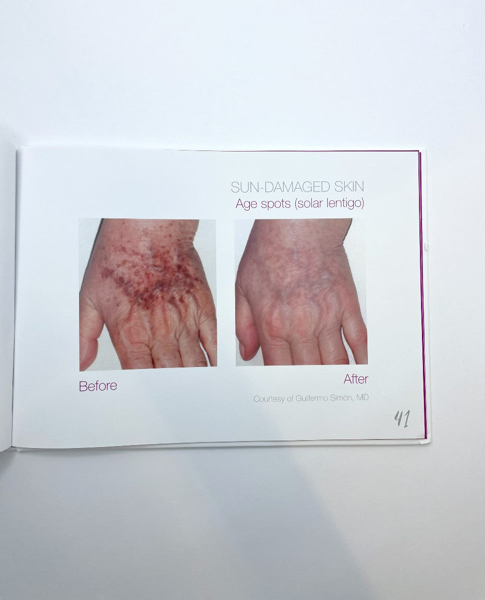 Candela Nordlys Reveal Your Inner Beauty Before and After Booklet