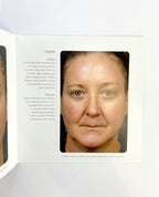 FRAXEL SOLTA MEDICAL BROCHURE PATIENT DIARY 27/pk