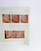 CUTERA, PEARL TM, CLINICAL ROUNDTABLE BROCHURE 2007