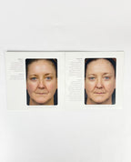 FRAXEL SOLTA MEDICAL BROCHURE PATIENT DIARY 28/pk