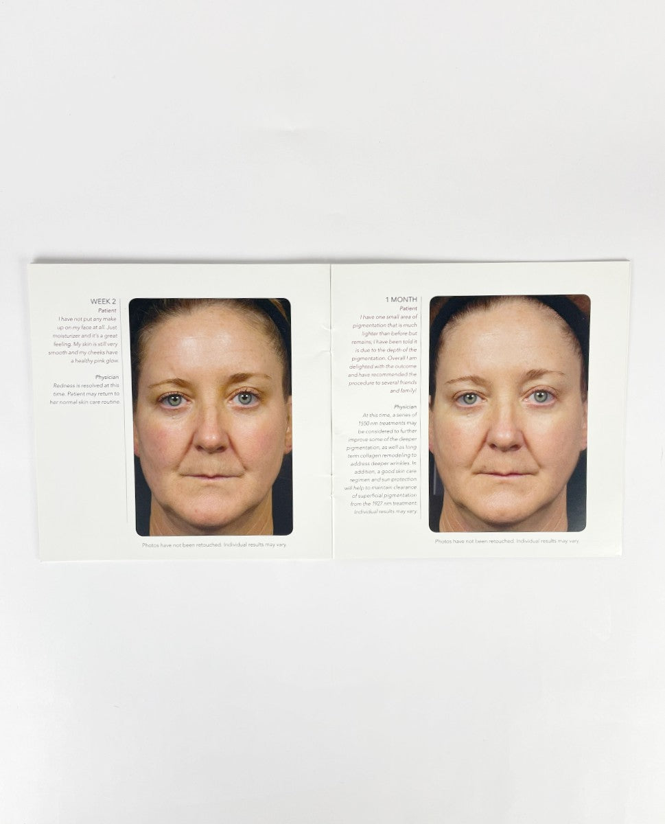 FRAXEL SOLTA MEDICAL BROCHURE PATIENT DIARY 28/pk