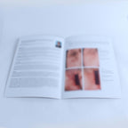 Asclepion MeDioStar HC Acne Inverse Hidradenitis Suppurativa Case Reports Flyers