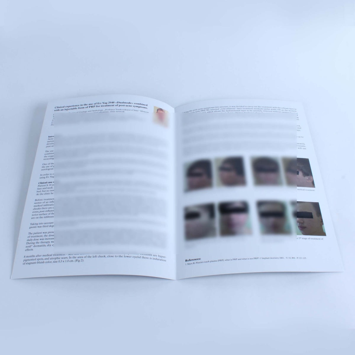 Asclepion MCL31 Dermablate ErYAG 2940 Laser Acne Treatment Case Report Brochures