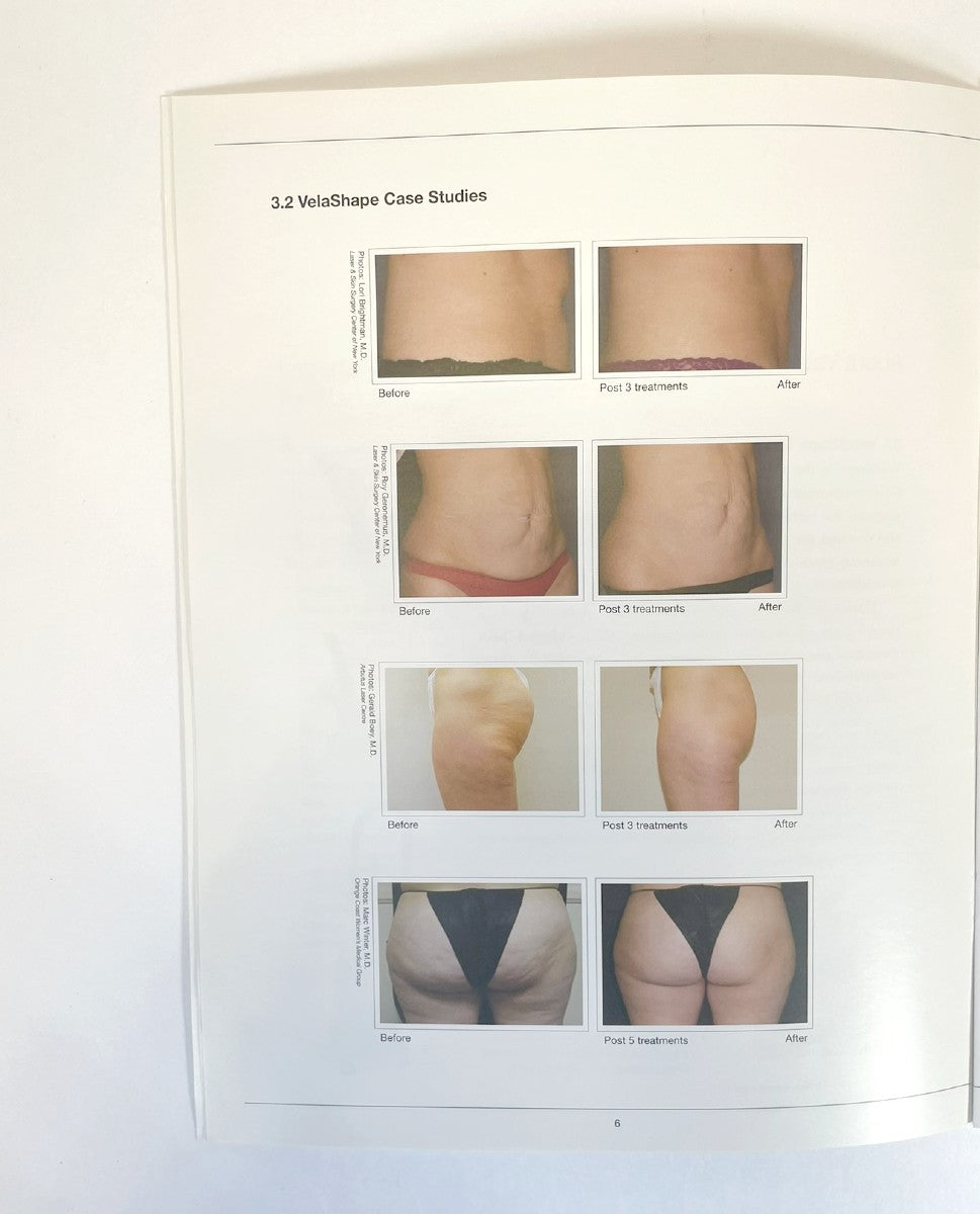 Syneron Clinical Evaluation of the Velashape Patient