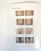 Syneron Clinical Evaluation of the Velashape Patient