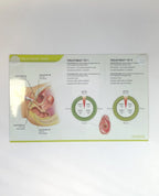 VIVEVE, SUI TREATMENT MAP SHEET