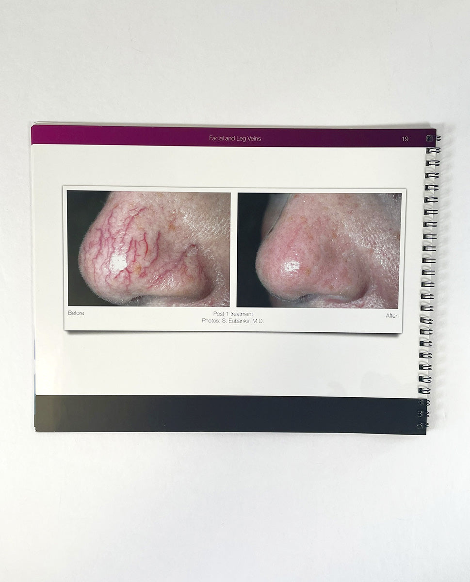 Candela GentleMax Pro A Before and After Booklet Marketing Booklet PB76861EN-NA