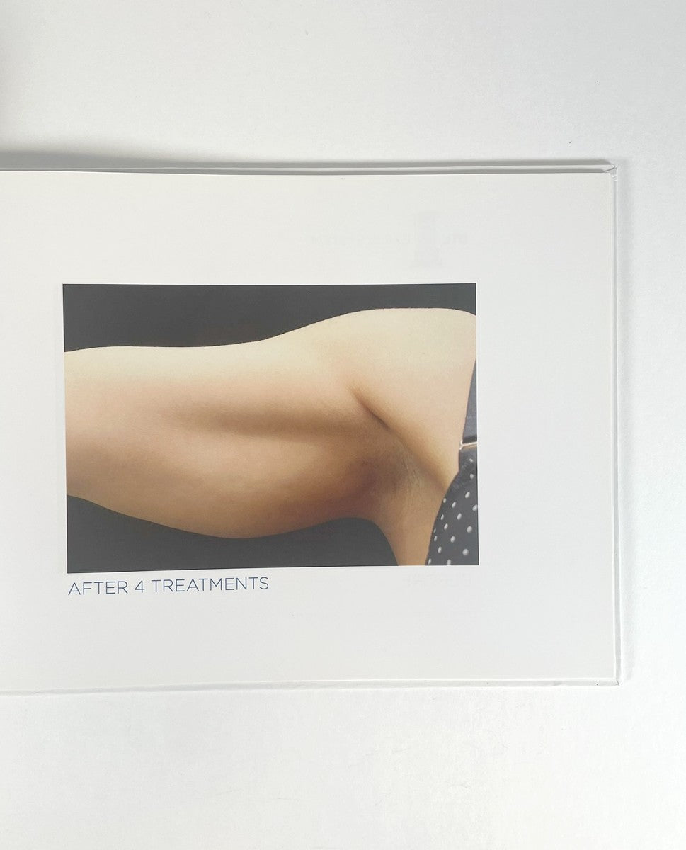BTL EXILIS SYSTEM 715-74 EXBABOOKEN100