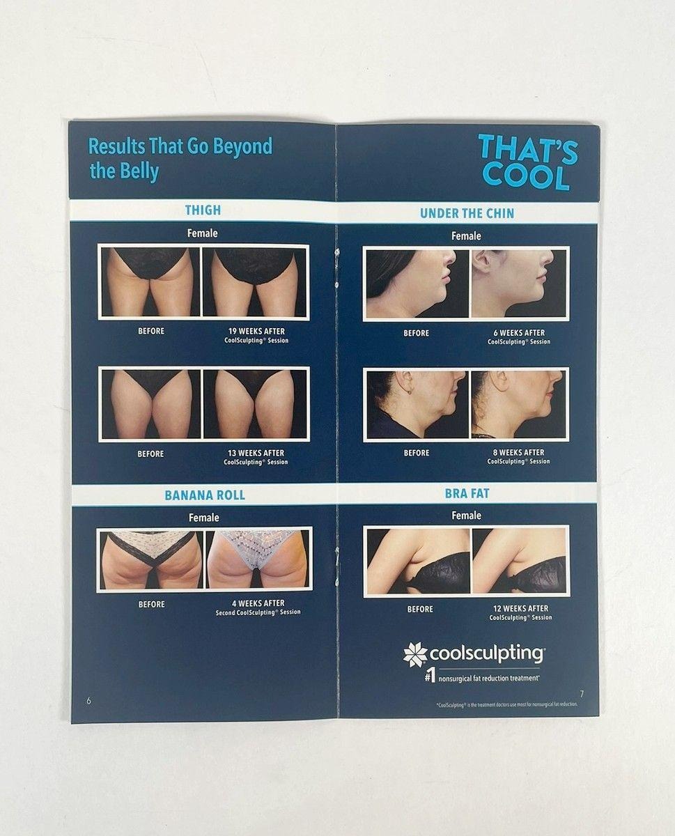 Zeltiq CoolSculpting Allergan That's Cool Marketing Brochure x4
